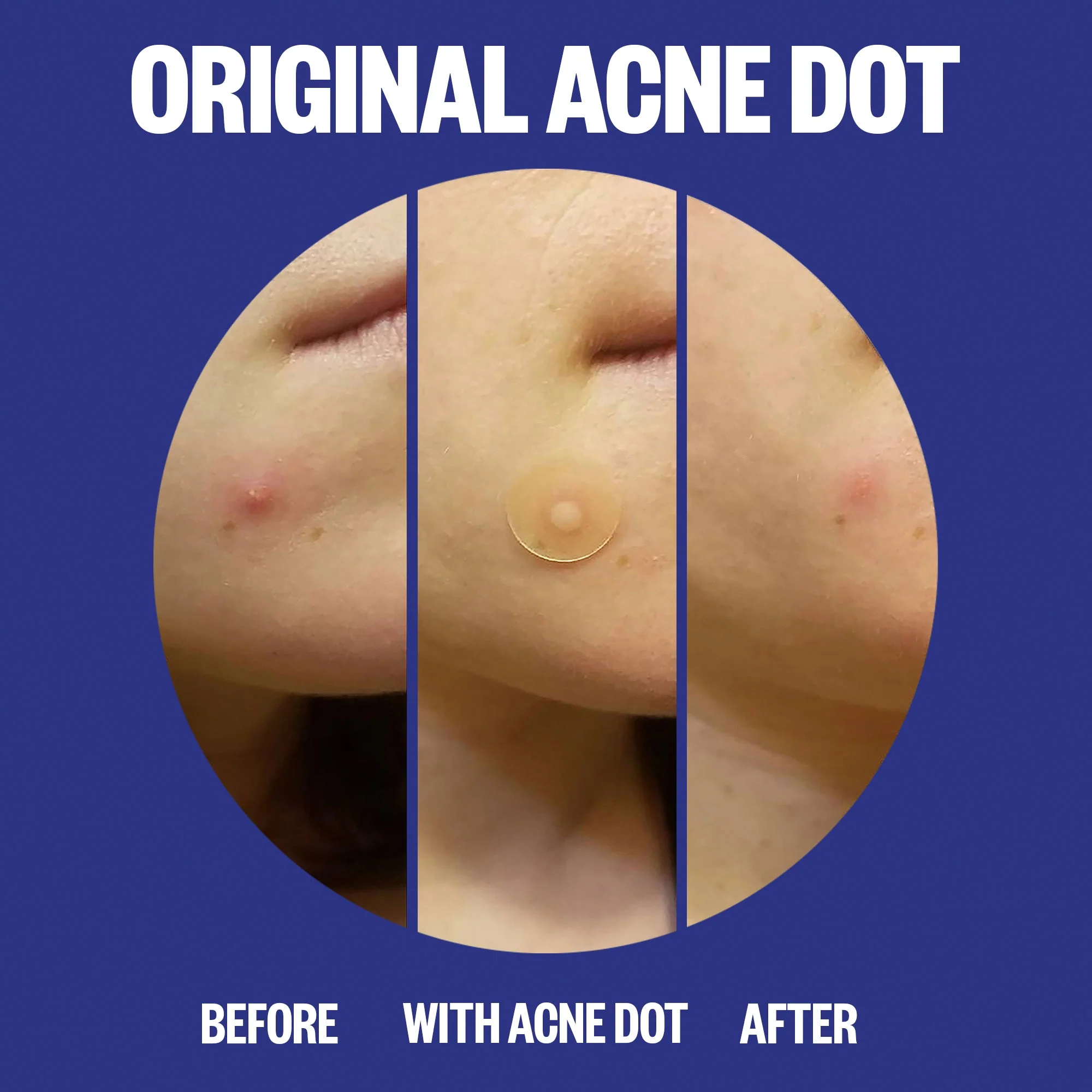 Acne Day & Night Duo (UNI) - Image 4