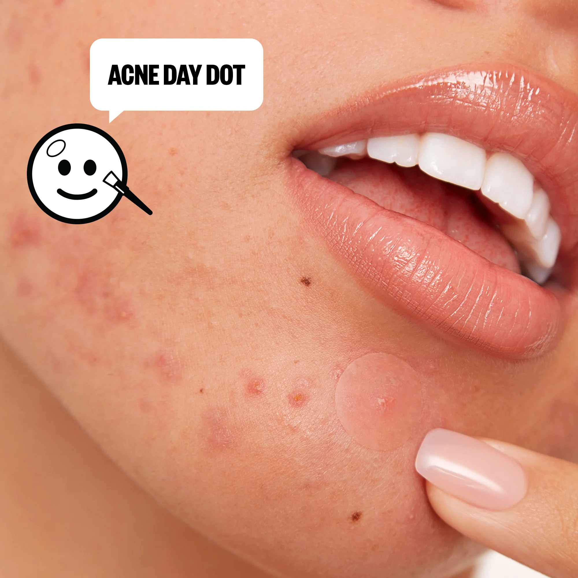Acne Day & Night Duo - Image 8