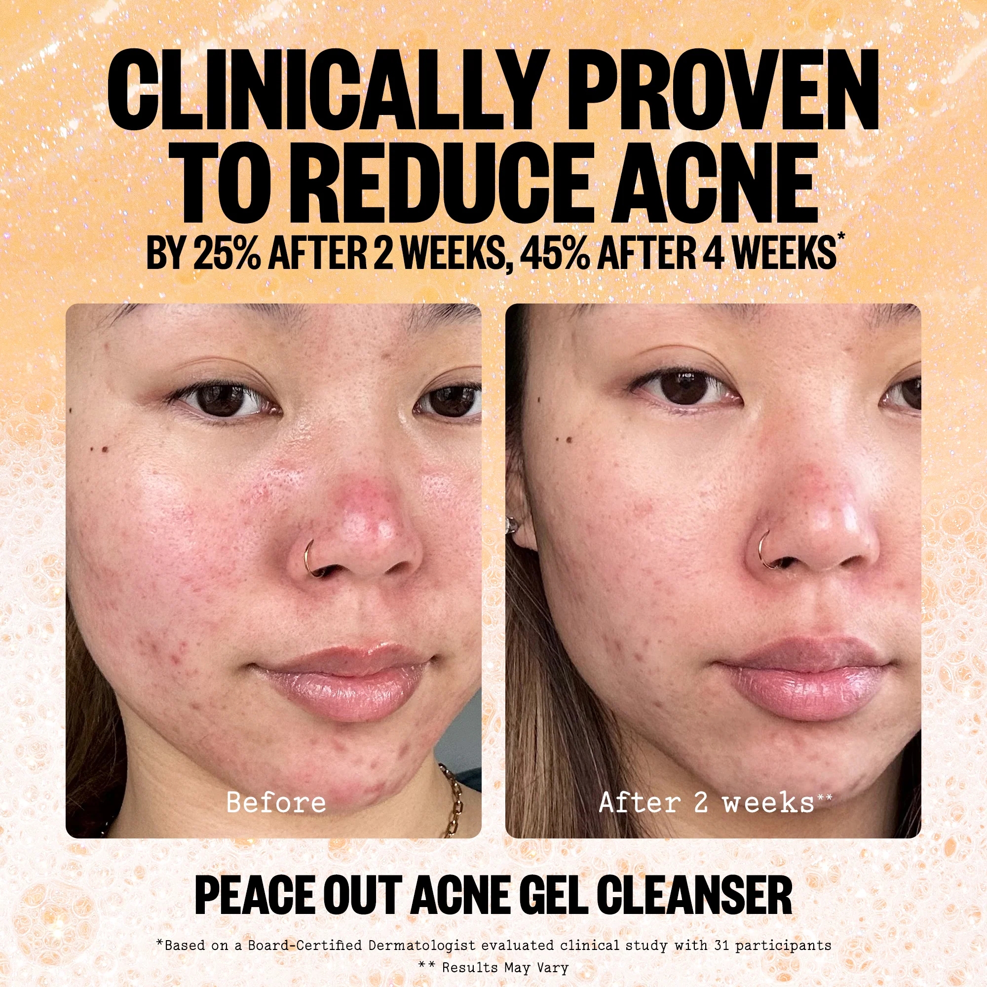 Acne Gel Cleanser (CAN) - Image 6