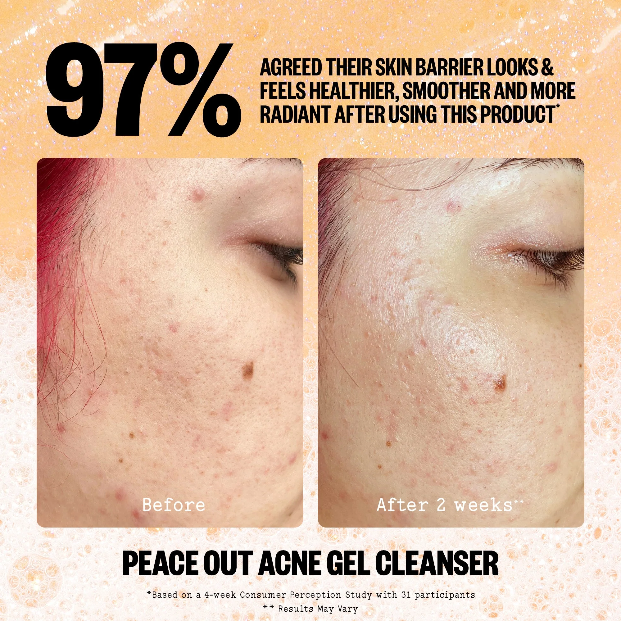 Acne Gel Cleanser (CAN) - Image 9