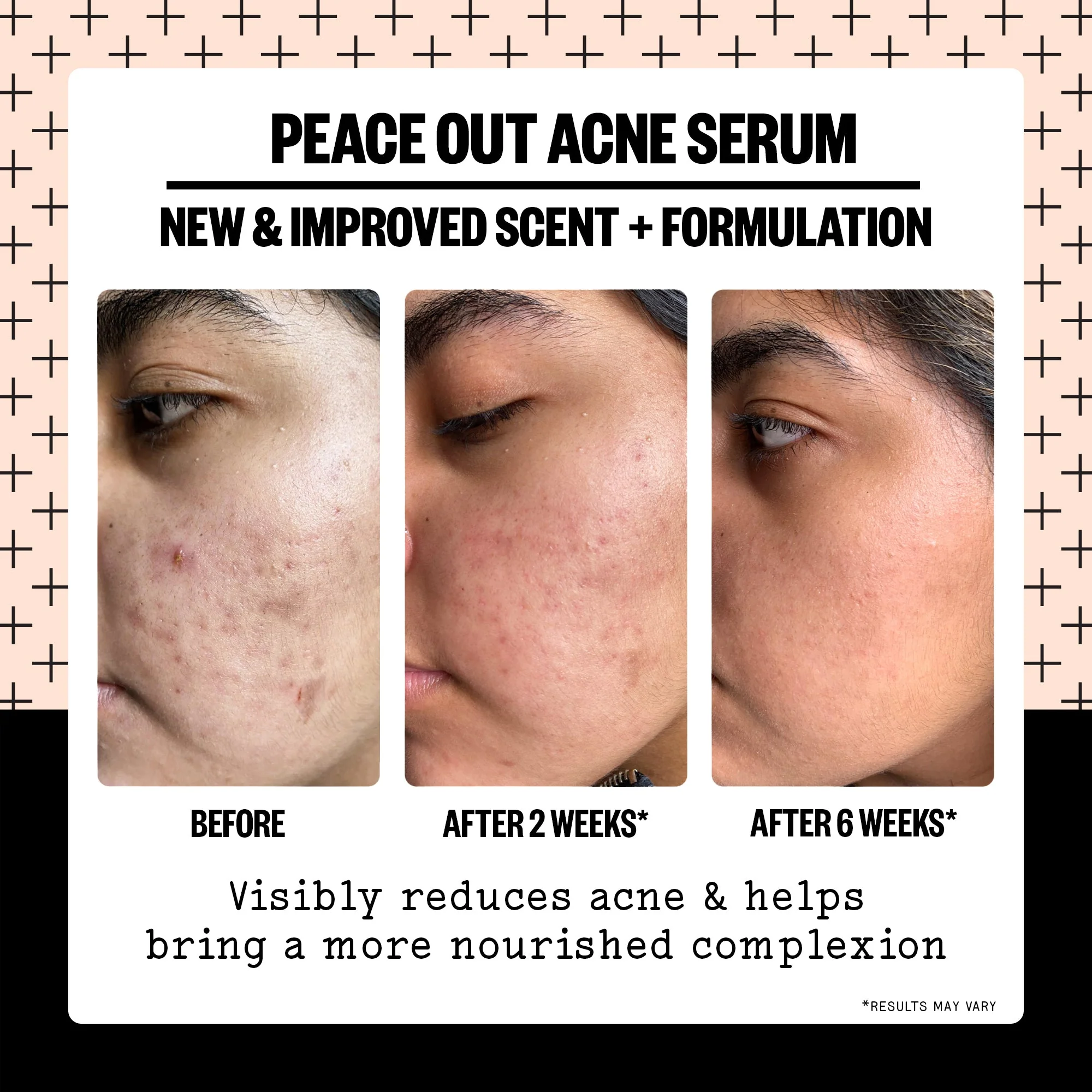 Acne Serum (CAN) - Image 4