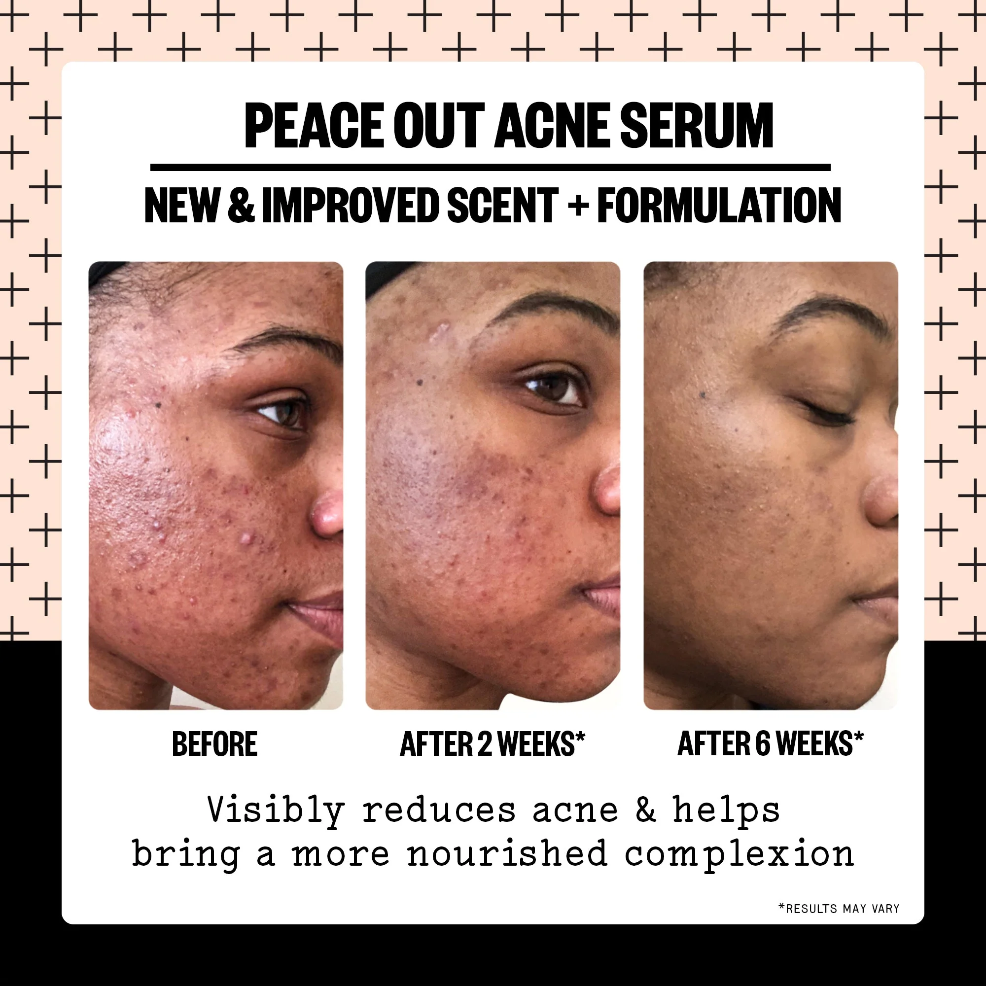 Acne Serum (UNI) - Image 3