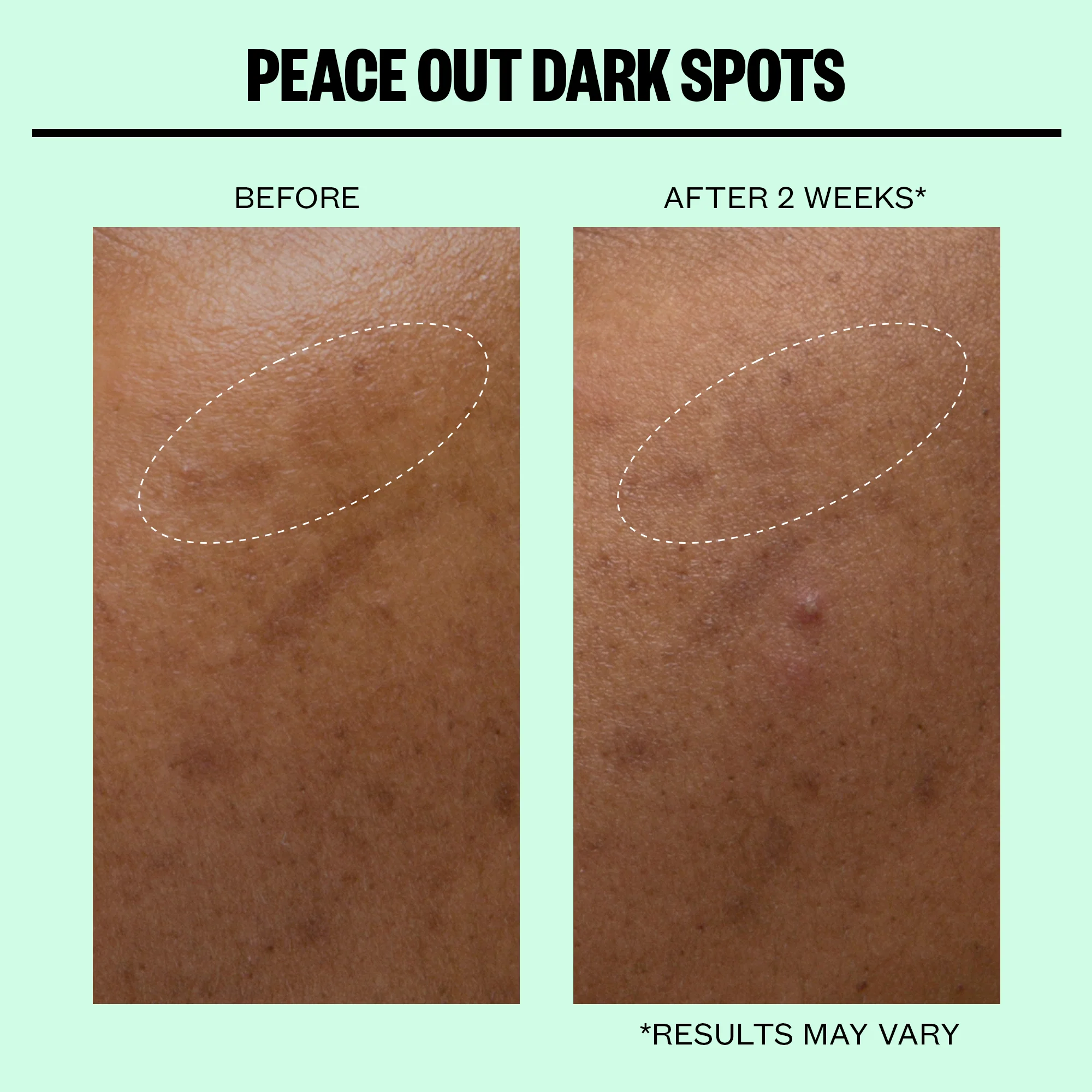 Dark Spots Microneedling Dots (CAN) - Image 5