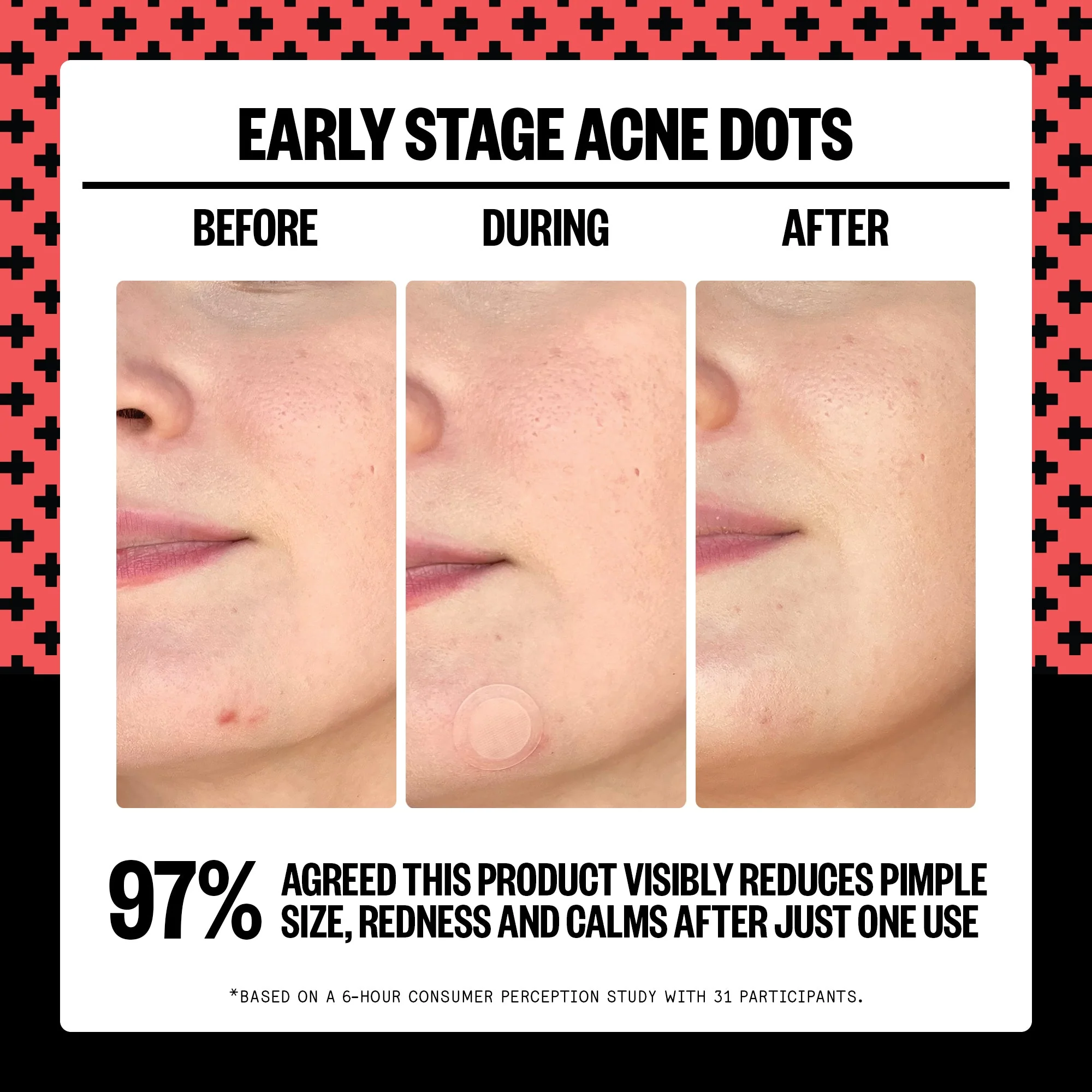 Early Stage Acne Dots (CAN) - Image 2