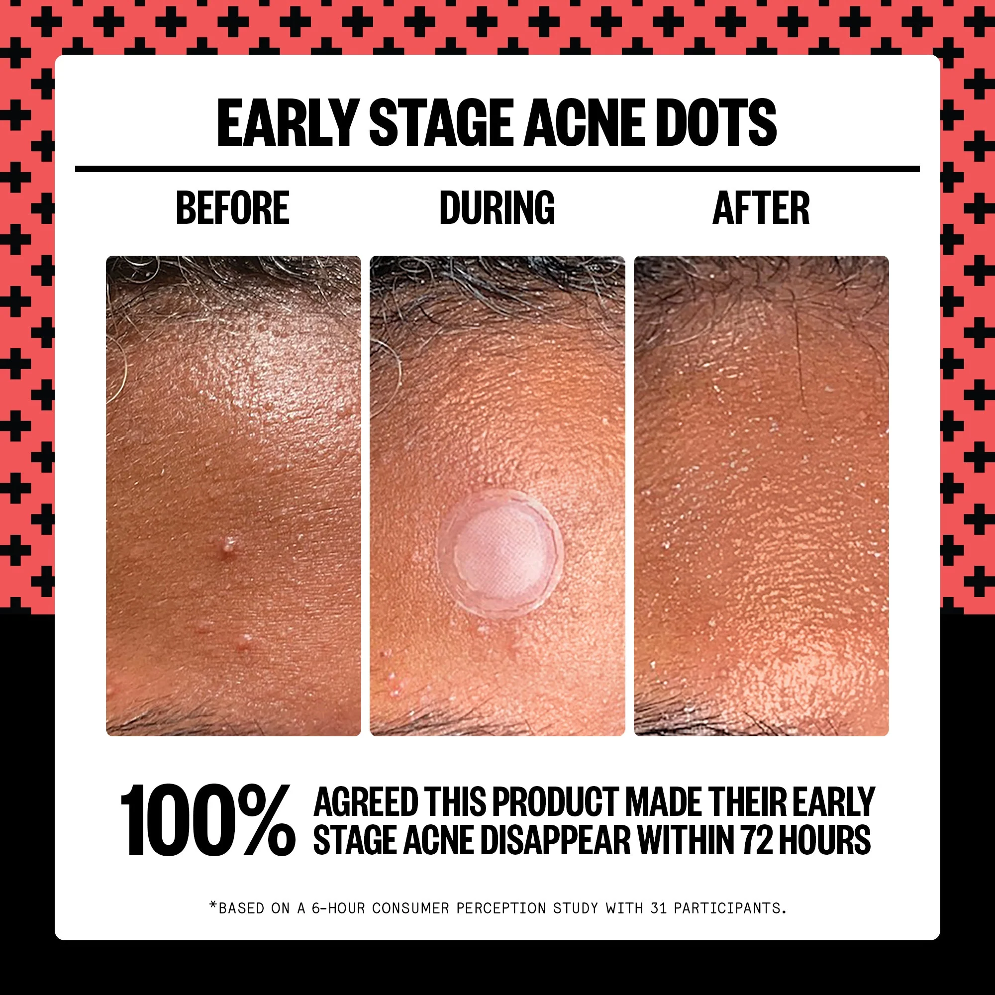 Early Stage Acne Dots (CAN) - Image 3