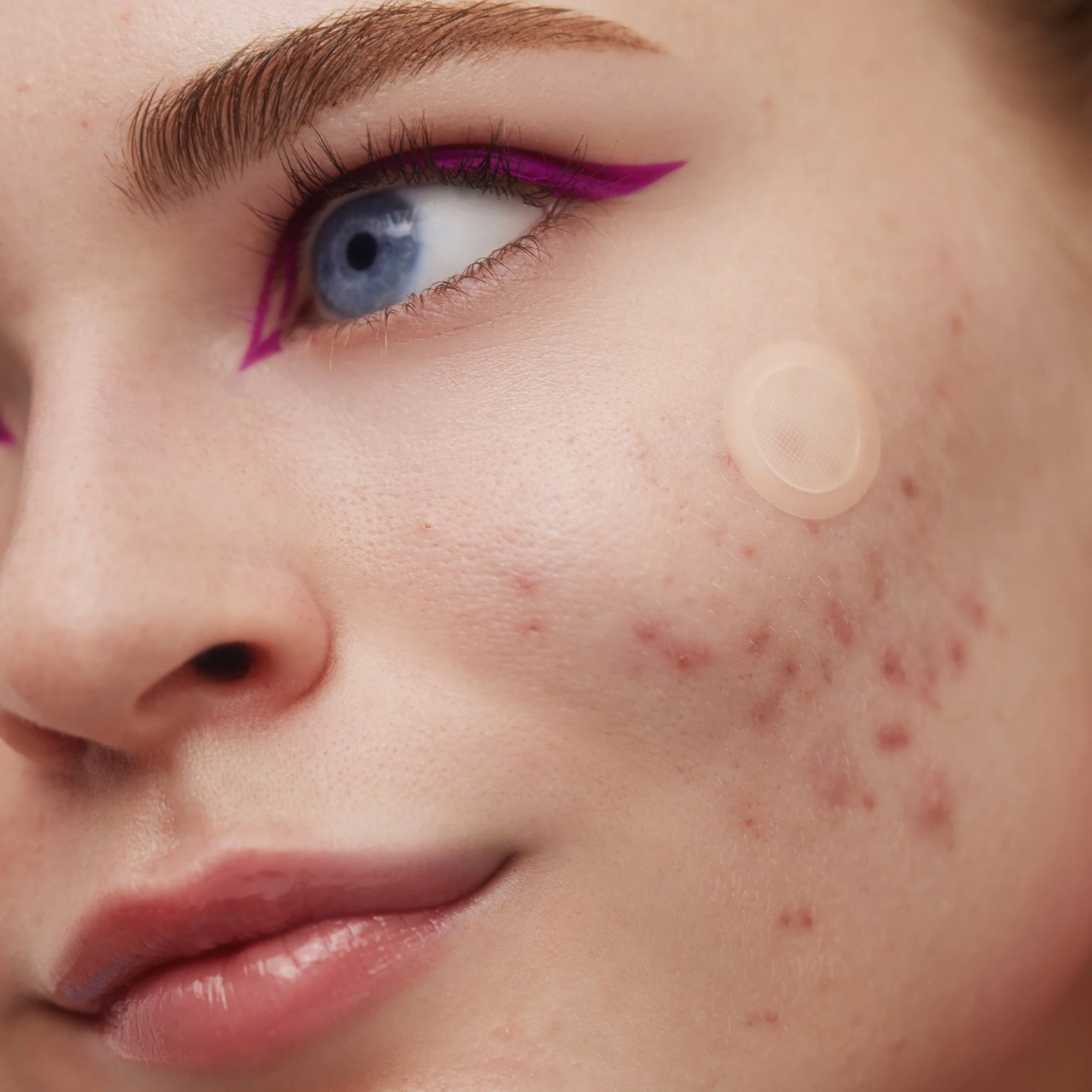 Early Stage Acne Dots (CAN) - Image 6