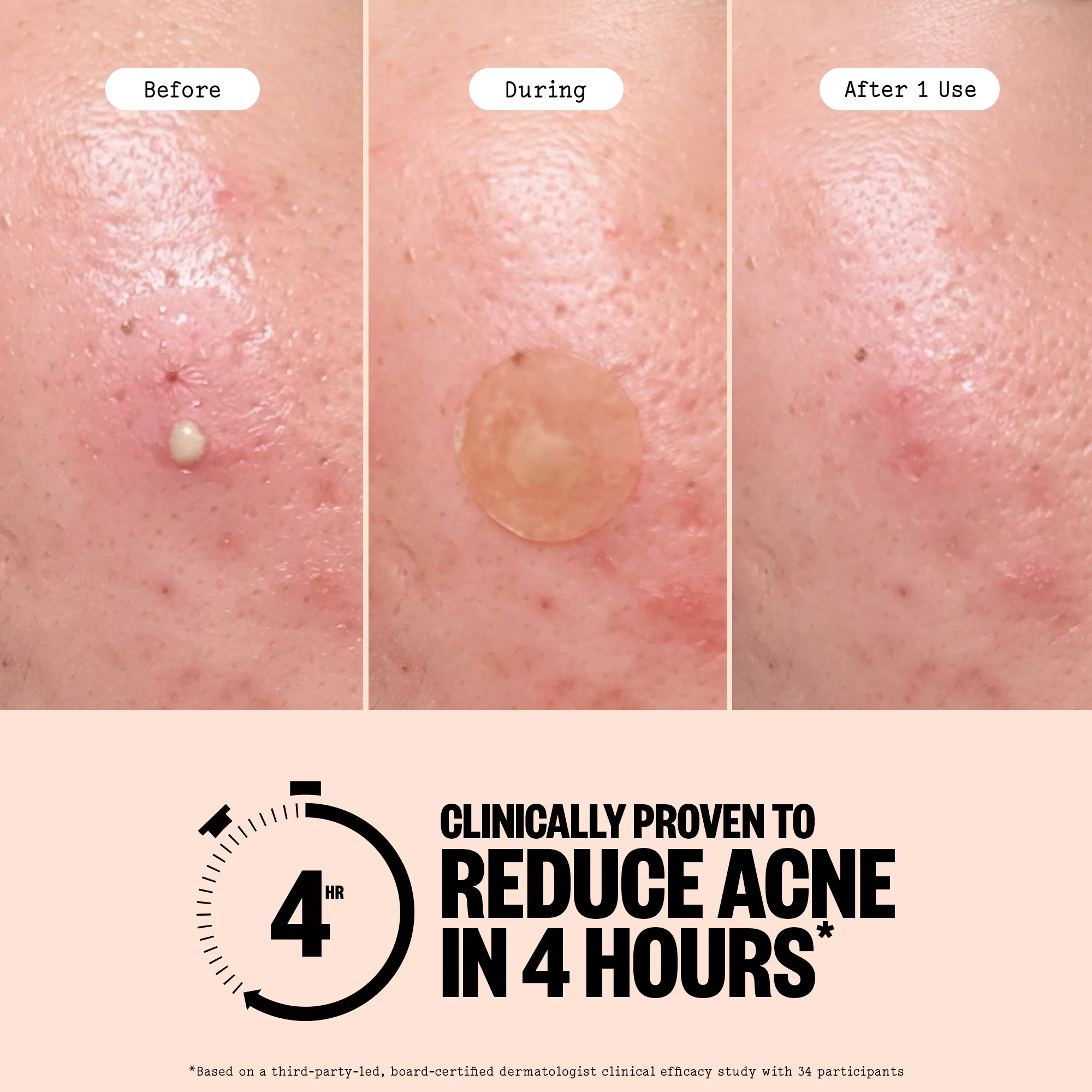 Acne Treatment Dots - Image 6