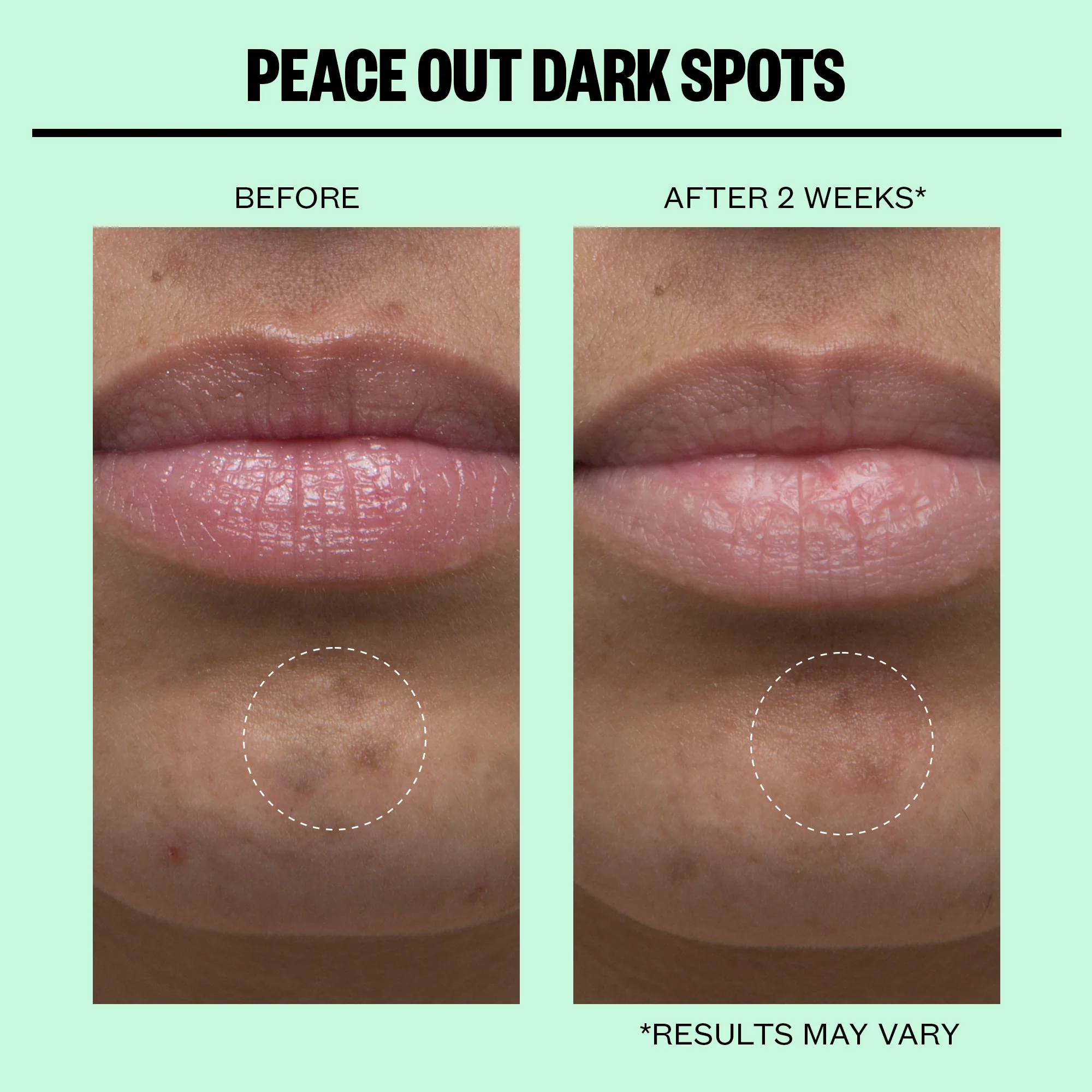 Dark Spots Microneedling Dots - Image 3